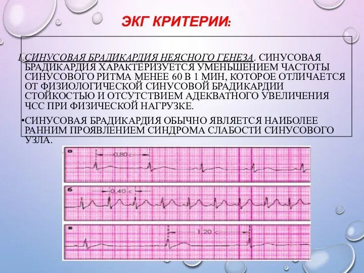 ЭКГ КРИТЕРИИ: СИНУСОВАЯ БРАДИКАРДИЯ НЕЯСНОГО ГЕНЕЗА. СИНУСОВАЯ БРАДИКАРДИЯ ХАРАКТЕРИЗУЕТСЯ УМЕНЬШЕНИЕМ ЧАСТОТЫ