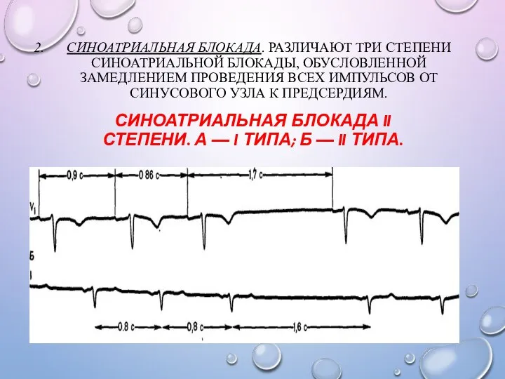 СИНОАТРИАЛЬНАЯ БЛОКАДА. РАЗЛИЧАЮТ ТРИ СТЕПЕНИ СИНОАТРИАЛЬНОЙ БЛОКАДЫ, ОБУСЛОВЛЕННОЙ ЗАМЕДЛЕНИЕМ ПРОВЕДЕНИЯ ВСЕХ