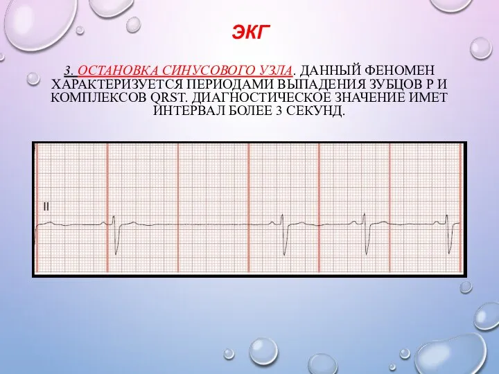 ЭКГ 3. ОСТАНОВКА СИНУСОВОГО УЗЛА. ДАННЫЙ ФЕНОМЕН ХАРАКТЕРИЗУЕТСЯ ПЕРИОДАМИ ВЫПАДЕНИЯ ЗУБЦОВ