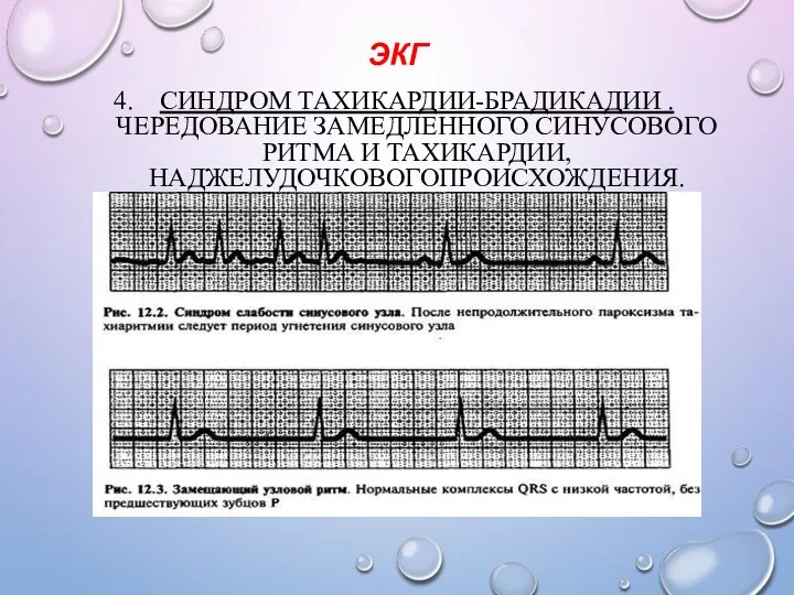 ЭКГ СИНДРОМ ТАХИКАРДИИ-БРАДИКАДИИ . ЧЕРЕДОВАНИЕ ЗАМЕДЛЕННОГО СИНУСОВОГО РИТМА И ТАХИКАРДИИ, НАДЖЕЛУДОЧКОВОГОПРОИСХОЖДЕНИЯ.