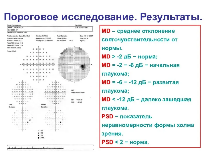 Пороговое исследование. Результаты. MD – среднее отклонение светочувствительности от нормы. MD