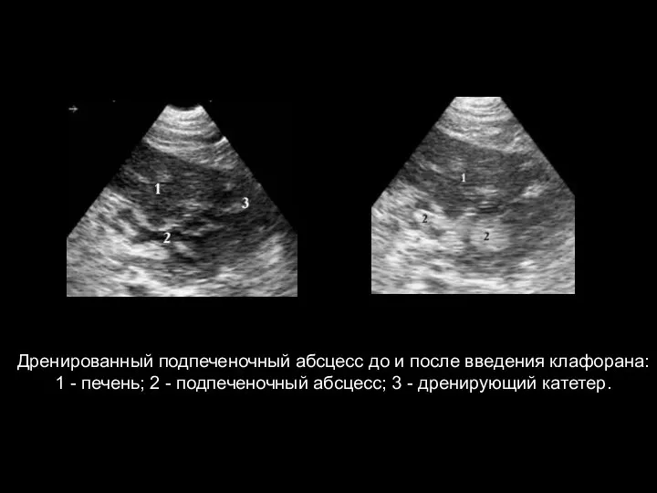 Дренированный подпеченочный абсцесс до и после введения клафорана: 1 - печень;