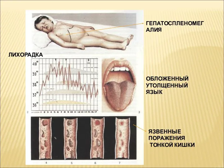 ГЕПАТОСПЛЕНОМЕГАЛИЯ ОБЛОЖЕННЫЙ УТОЛЩЕННЫЙ ЯЗЫК ЯЗВЕННЫЕ ПОРАЖЕНИЯ ТОНКОЙ КИШКИ ЛИХОРАДКА