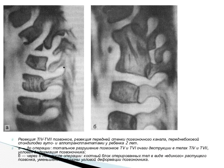 Резекция TIV-ТVII позвонков, резекция передней стенки позвоночного канала, переднебоковой спондилодез ауто-