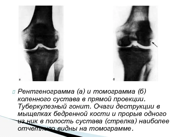 Рентгенограмма (а) и томограмма (б) коленного сустава в прямой проекции. Туберкулезный