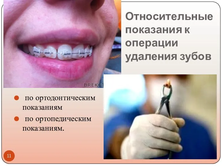 Относительные показания к операции удаления зубов по ортодонтическим показаниям по ортопедическим показаниям.