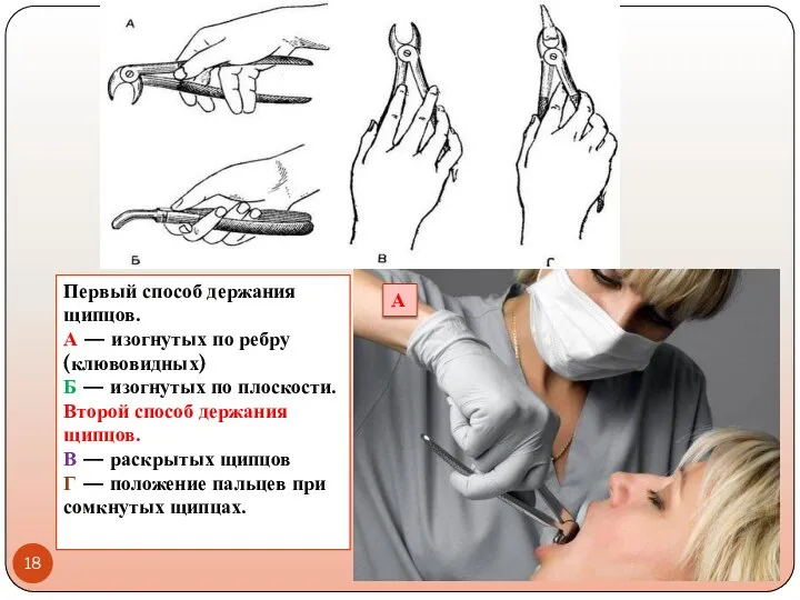 Первый способ держания щипцов. А — изогнутых по ребру (клювовидных) Б