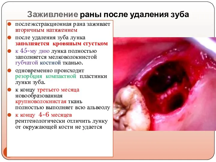 Заживление раны после удаления зуба послеэкстракционная рана заживает вторичным натяжением после