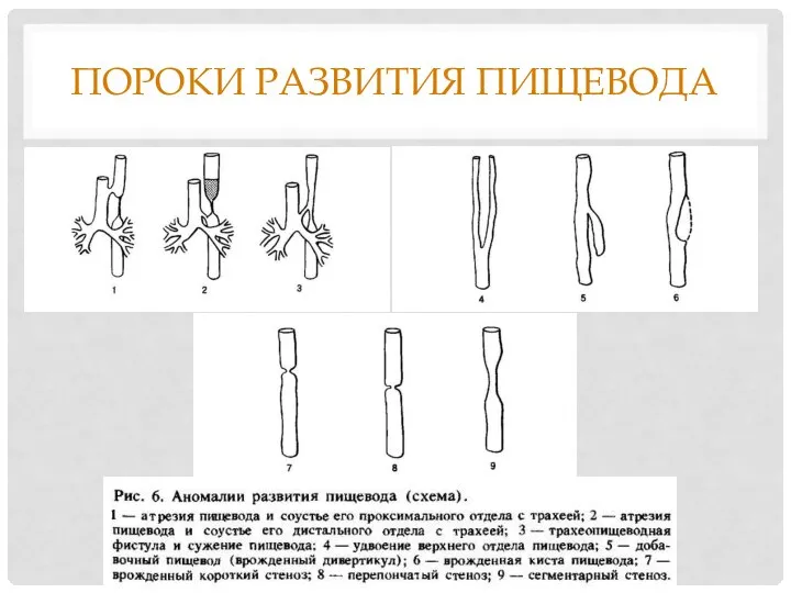 ПОРОКИ РАЗВИТИЯ ПИЩЕВОДА