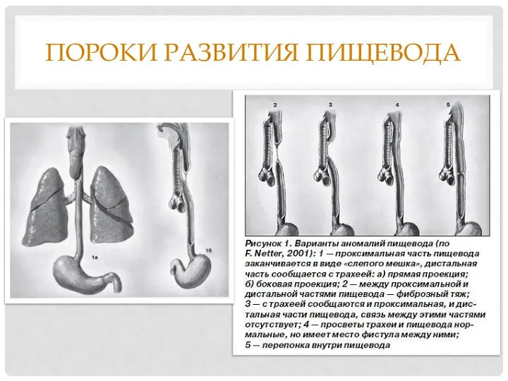 ПОРОКИ РАЗВИТИЯ ПИЩЕВОДА