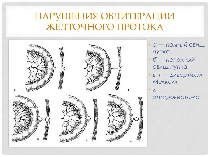НАРУШЕНИЯ ОБЛИТЕРАЦИИ ЖЕЛТОЧНОГО ПРОТОКА а — полный свищ пупка, б —