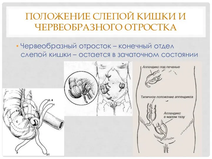 ПОЛОЖЕНИЕ СЛЕПОЙ КИШКИ И ЧЕРВЕОБРАЗНОГО ОТРОСТКА Червеобразный отросток – конечный отдел