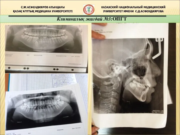 Клиникалық жағдай №3:ОПГТ