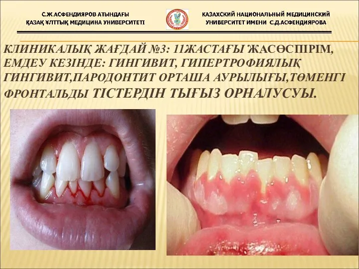 КЛИНИКАЛЫҚ ЖАҒДАЙ №3: 11ЖАСТАҒЫ ЖАСӨСПІРІМ,ЕМДЕУ КЕЗІНДЕ: ГИНГИВИТ, ГИПЕРТРОФИЯЛЫҚ ГИНГИВИТ,ПАРОДОНТИТ ОРТАША АУРЫЛЫҒЫ,ТӨМЕНГІ ФРОНТАЛЬДЫ ТІСТЕРДІН ТЫҒЫЗ ОРНАЛУСУЫ.