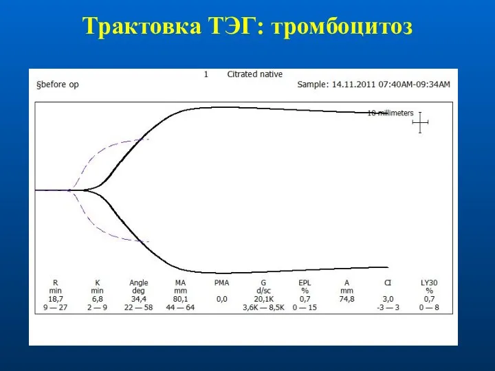 Трактовка ТЭГ: тромбоцитоз