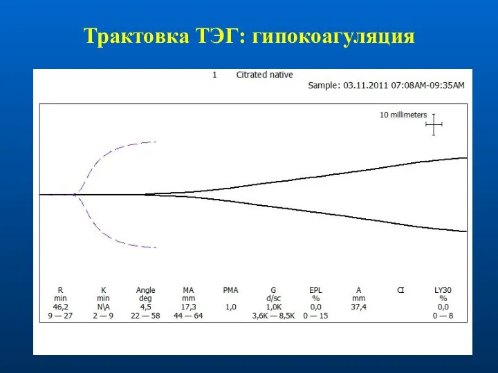 Трактовка ТЭГ: гипокоагуляция