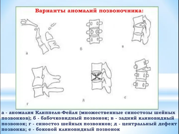 а - аномалия Клиппеля-Фейля (множественные синостозы шейных позвонков); б - бабочковидный