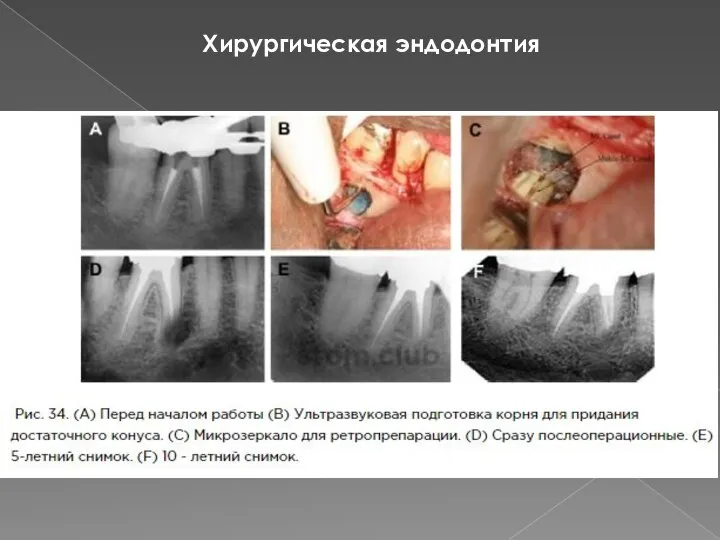 Хирургическая эндодонтия