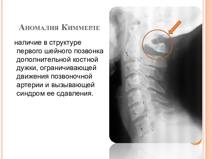 Аномалия Киммерле наличие в структуре первого шейного позвонка дополнительной костной дужки,