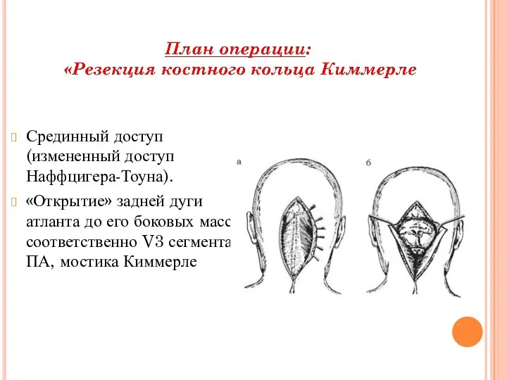 Срединный доступ (измененный доступ Наффцигера-Тоуна). «Открытие» задней дуги атланта до его