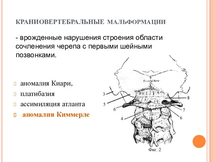 краниовертебральные мальформации аномалия Киари, платибазия ассимиляция атланта аномалия Киммерле - врожденные