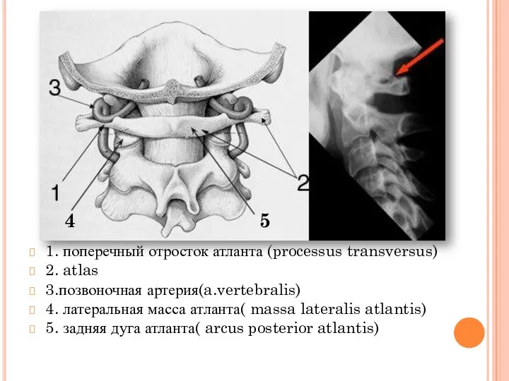 1. поперечный отросток атланта (processus transversus) 2. atlas 3.позвоночная артерия(a.vertebralis) 4.