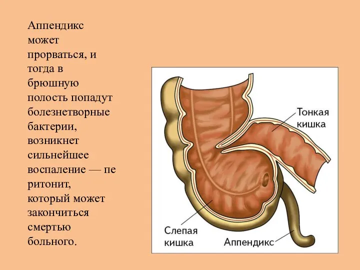 Аппендикс может прорваться, и тогда в брюшную полость попадут болезнетворные бактерии,