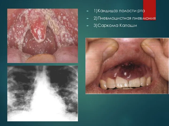 1)Кандидоз полости рта 2)Пневмоцистная пневмония 3)Саркома Капоши