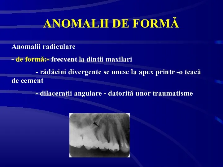 ANOMALII DE FORMĂ Anomalii radiculare - de formă:- frecvent la dintii