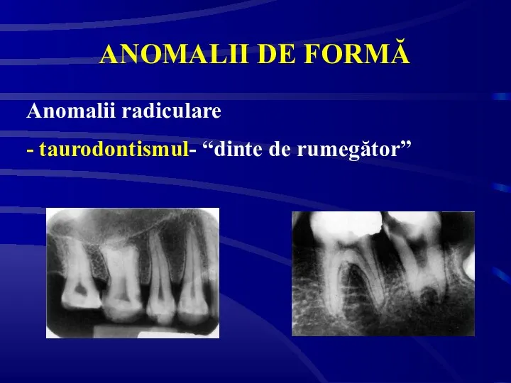 ANOMALII DE FORMĂ Anomalii radiculare - taurodontismul- “dinte de rumegător”