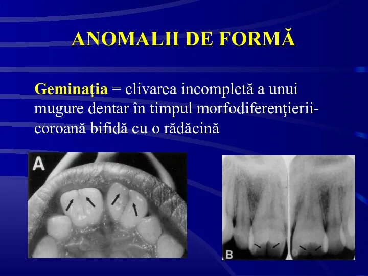 ANOMALII DE FORMĂ Geminaţia = clivarea incompletă a unui mugure dentar