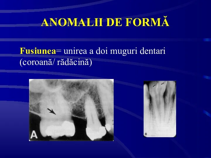ANOMALII DE FORMĂ Fusiunea= unirea a doi muguri dentari (coroană/ rădăcină)