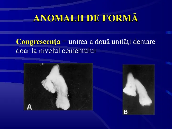 ANOMALII DE FORMĂ Congrescenţa = unirea a două unităţi dentare doar la nivelul cementului