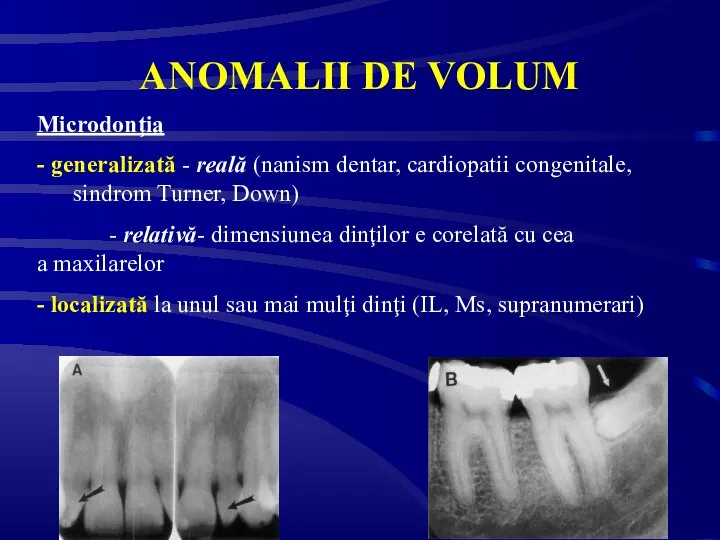 ANOMALII DE VOLUM Microdonţia - generalizată - reală (nanism dentar, cardiopatii