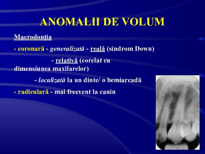 ANOMALII DE VOLUM Macrodonţia - coronară - generalizată - reală (sindrom