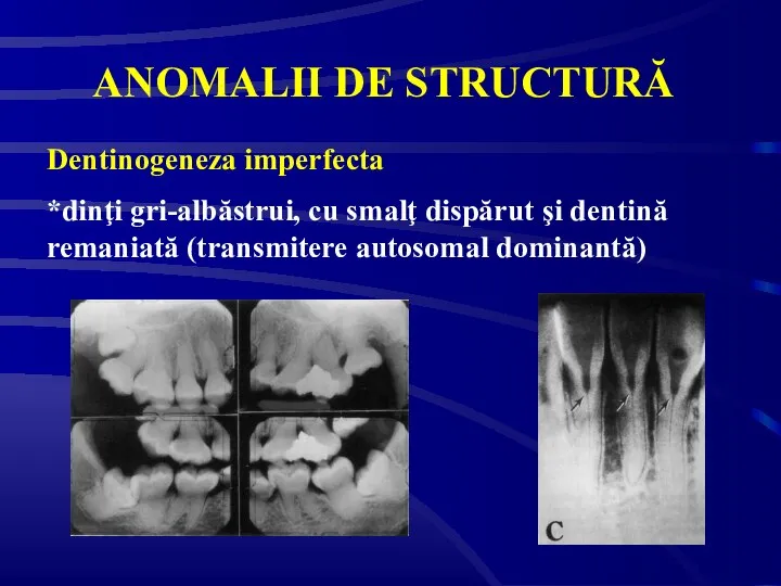 ANOMALII DE STRUCTURĂ Dentinogeneza imperfecta *dinţi gri-albăstrui, cu smalţ dispărut şi dentină remaniată (transmitere autosomal dominantă)