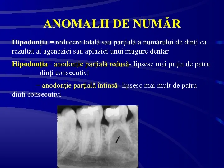 ANOMALII DE NUMĂR Hipodonţia = reducere totală sau parţială a numărului