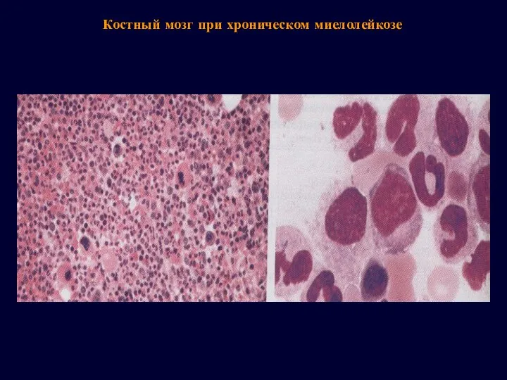 Костный мозг при хроническом миелолейкозе