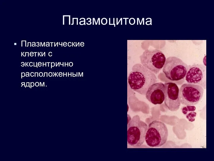 Плазмоцитома Плазматические клетки с эксцентрично расположенным ядром.