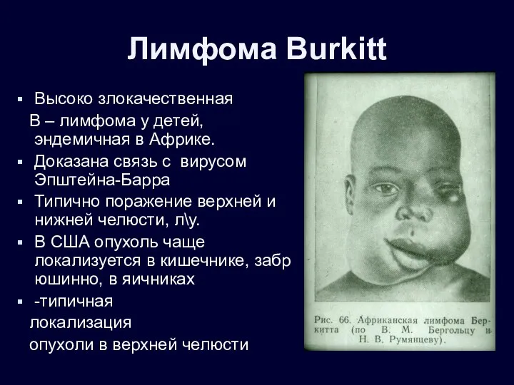 Лимфома Burkitt Высоко злокачественная В – лимфома у детей, эндемичная в