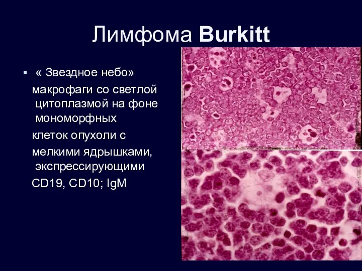 Лимфома Burkitt « Звездное небо» макрофаги со светлой цитоплазмой на фоне