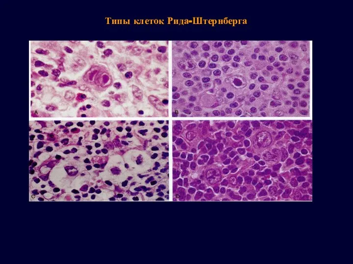 Типы клеток Рида-Штернберга
