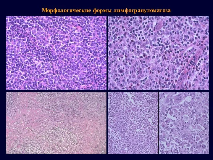 Морфологические формы лимфогрануломатоза