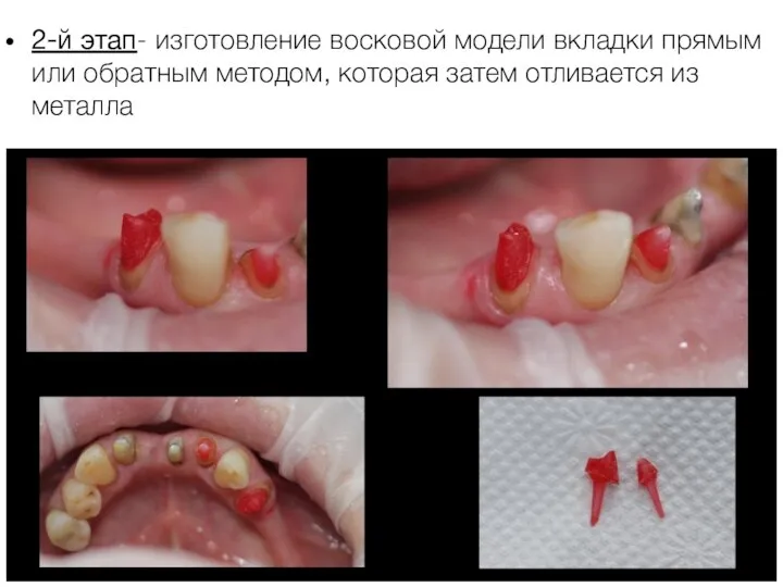 2-й этап- изготовление восковой модели вкладки прямым или обратным методом, которая затем отливается из металла