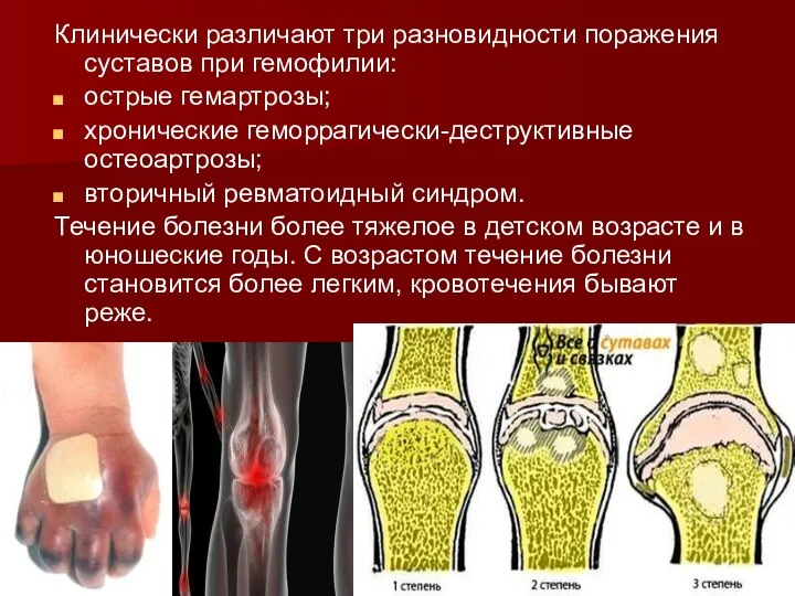 Клинически различают три разновидности поражения суставов при гемофилии: острые гемартрозы; хронические