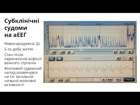 Субклінічні судоми на аЕЕГ Новонароджена Ш. 5-та доба життя Стан після