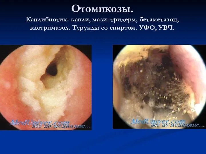 Отомикозы. Кандибиотик- капли, мази: тридерм, бетаметазон, клотримазол. Турунды со спиртом. УФО, УВЧ.