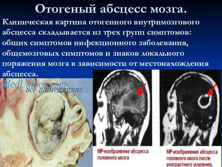 Отогеный абсцесс мозга. Клиническая картина отогенного внутримозгового абсцесса складывается из трех