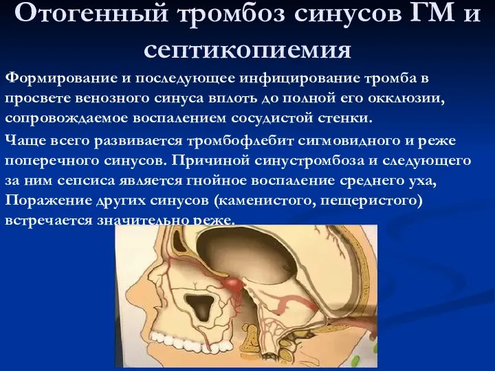 Отогенный тромбоз синусов ГМ и септикопиемия Формирование и последующее инфицирование тромба