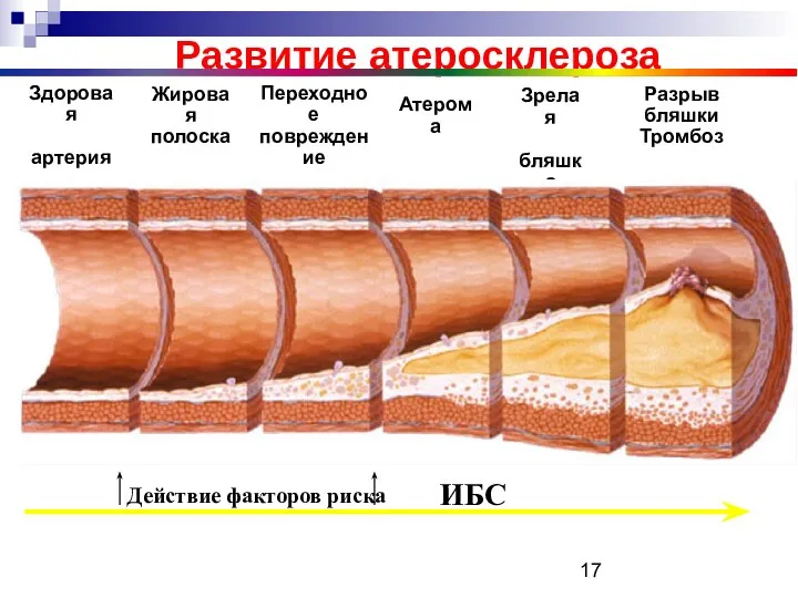 Развитие атеросклероза Здоровая артерия Жировая полоска Переходное повреждение Атерома Зрелая бляшка